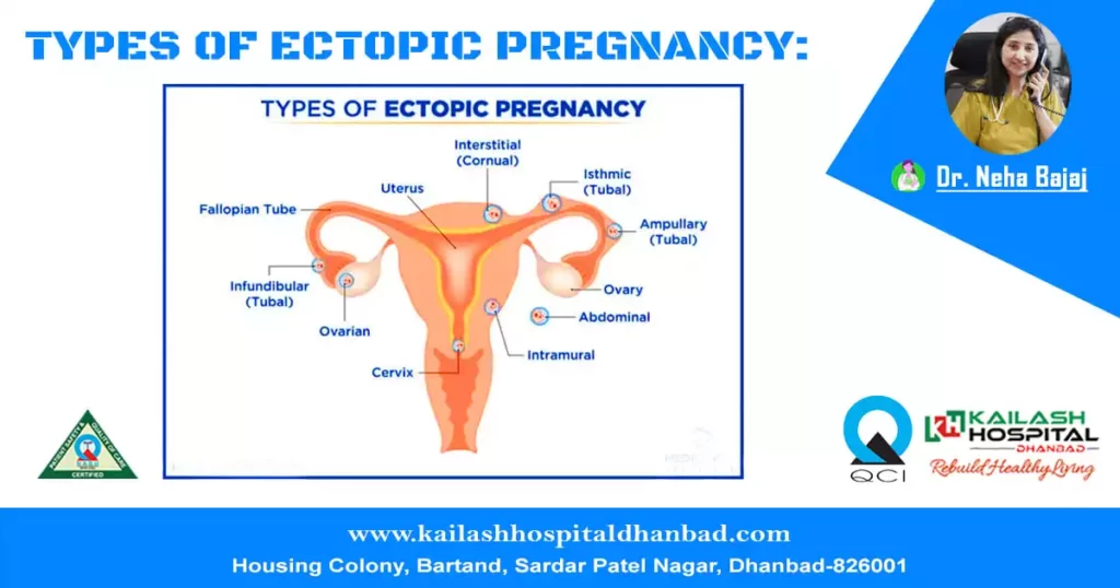 types-of-ectopic-pregnancy